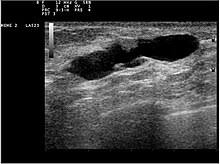 الورم الحليمي القنوي في الثدي ويكيبيديا