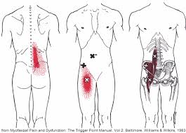 Effect of personalized musculoskeletal geometry outweighs the effect of personalized neural control Psoas Syndrome Overlooked Cause Of Back Hip Groin Pain