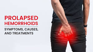 Image result for hemorrhoids