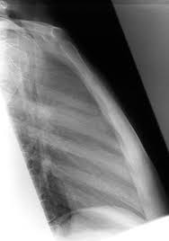 Image result for Sternal Fracture