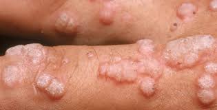 Image result for human papilloma virus