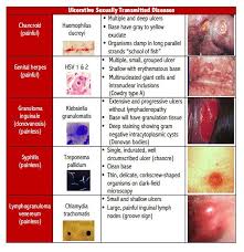 Image result for chancroid