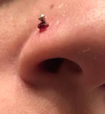 Nose Piercing Bump 2nd Post Now Blister Has Hardened A Little Album On Imgur
