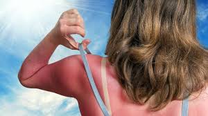 Image result for Sunburn