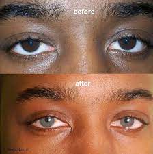 Coloboma Versus Change The Color Of Your Eyes Eye Care Getoct Com Professional Messages Change Your Eye Color Eye Color Change Eye Color Facts