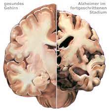 A progressive disease beginning with mild memory loss possibly leading to loss of the ability to carry on a conversation and respond to the environment. Gesundes Gehirn Gegen Alzheimer Gehirn Alzheimer S Association