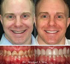 Braverman is one of the leading nyc cosmetic dentist's and has created winning smiles for new york city models, tv and . Dr Wei Improves Kris Smile With Porcelain Veneers And Tooth Fillings
