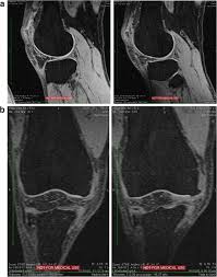 What are the risks of an mri of the knee? Mri Detected Osteophytes Of The Knee Natural History And Structural Correlates Of Change Arthritis Research Therapy Full Text