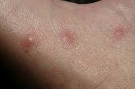Clinically and histologically, it is consistent with pustular psoriasis. Psoriasis Pustulosa Sonderform Der Schuppenflechte Mit Eiterblaschen