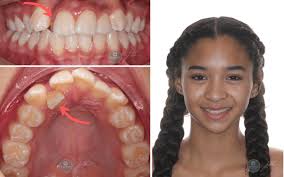 There are many different types and sizes of elastics. Orthodontic Case Of Anterior Crossbite Rucker Orthodontics