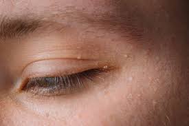 Image result for xantelasma