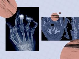 Image result for XRay Changes in Rheumatic Conditions