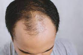 Hello, hair loss is not a common side effect of beta blockers. High Blood Pressure Could Your Hair Loss Be An Early Warning Sign Of The Condition Top Personal Health