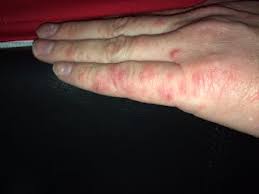 A rash on the soles of the feet and palms of the hand, sometimes with peeling skin. Hand Foot And Mouth Disease In Adults Medical Facts