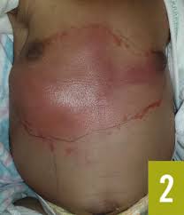 It occurs commonly among nursing mothers, when bacteria enters the breast through sore, cracked nipples. Mastitis In A Neonate Pediatrics