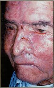 CARCINOMAS FACIALES MULTIPLES DE ALTA AGRESIVIDAD, MANEJO Y TECNICAS DE  RECONSTRUCCIÓN QUIRÚRGICA