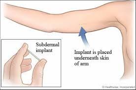 Arm Implant Birth Control Std Free Los Angeles Nexplanon Birth Control Implant Birth Control Birth Control Methods