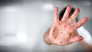 Die grünen lehnen harte freiheitseingriffe für ungeimpfte ab. Masern Impfung Fur Kita Besuch Ab 1 Marz Gilt Masernschutzgesetz Rhein Main