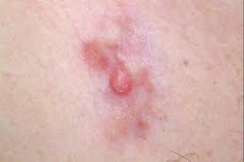 Image result for Dermatofibrosarcoma Protuberans
