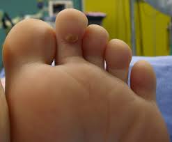 Impiedica evaporarea apei si micsoreaza pierderea de lichid din epiderma (taieturi, zgarieturi). Clavusul Sau Batatura Dr Vladislav Gyebnar