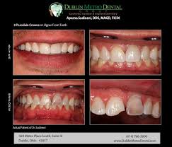 Curvy Dental Crowns Before And After Health Teethwhiteningmalaysia Dentalcrowncases Dental Crowns Implant Dentistry Dental Bridge