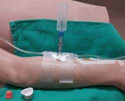 Blood Sampling From An Indwelling Line | Lhsc