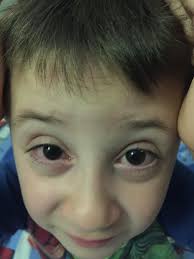 Leonardo, 5 anni a settembre, da maggio ha iniziato a soffrire di  congiuntivite...circa 3 settimane fa abbiamo fatto una visita a pagamento e  gli è stata diagnosticata la Vernal in forma medio/lieve