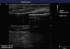Case Report: Endovascular Salvage of an Abandoned AV Graft - Endovascular  Today
