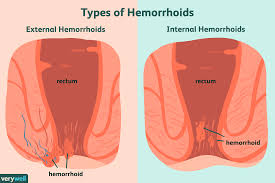 Illustration of the external hemorrhoidal plexus and external hemorrhoids. Hemorrhoids Overview And More