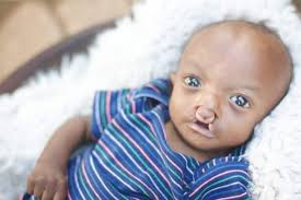 Hội chứng Edwards (Trisomy 18): Nguyên nhân, triệu chứng và cách điều trị