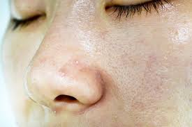 Maybe you would like to learn more about one of these? Whiteheads On Nose Causes And How To Get Rid Of Them Asap