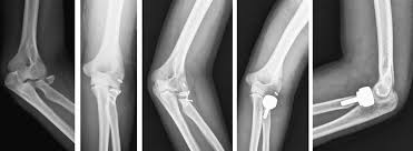 Image result for Radial Head Dislocation