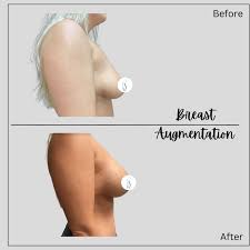 Image result for Breast Augmentation