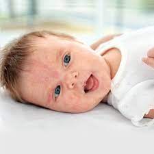 Dairy Overload Dairy Intolerance And Dairy Allergy Cmpa