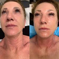 Best Facial Treatments in Dallas