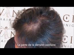 La perte de cheveux est un problème qui concerne non seulement les hommes mais aussi les femmes. ØªØ¹Ø§ÙˆÙ† ÙŠØ±Ø« Ø§Ù„Ø³Ø§Ø¨Ù‚ Perte Densite Cheveux Femme Dsvdedommel Com