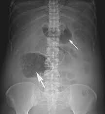 Image result for Adynamic Ileus
