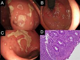 Image result for Proctitis