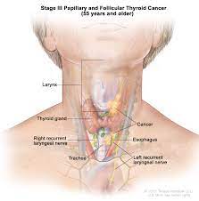 Fatigue can be a symptom of both forms of thyroid disease. Endocrine Surgery Thyroid Cancer