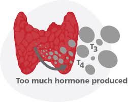 Metabolic Leader | Hyperthyroidism
