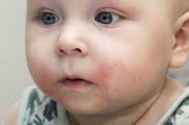 You look like matthew modine had a peanut allergy. Alergiile Alimentare Simptome Cauze Tratament PrevenÅ£ie Csid Ce Se IntamplÄ Doctore