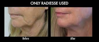 Video Non Surgical Jowl Lift In Los Angeles By Dr Umar