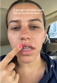 Effective Cold Sore Relief