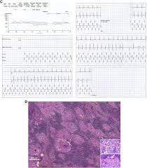 Innocent heart murmurs aren't a sign of heart disease and don't require treatment. Cardiac Magnetic Resonance Imaging Negative Cardiac Sarcoidosis Heartrhythm Case Reports
