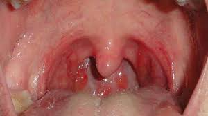 What Is Strep Throat Symptoms Signs Of Strep Throat Strep Throat Remedies Strep Throat Signs Of Strep Throat