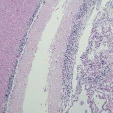 Treatment for secondary brain cancer the aim of treatment is usually to control the cancer and your symptoms. Metastatic Brain Tumors Johns Hopkins Medicine