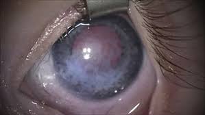 Image result for lesion sclera