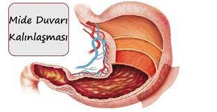 mide duvari kalinlasmasi nedir belirtileri ve tedavisi saglik haberleri saglik mide kanseri metabolizma