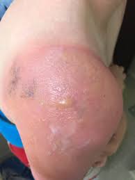 The reaction to sunscreens can occur anywhere the substance is applied on the body, although tends to be more common in the areas of the body with the most sun exposure. Some Kids May Be Sensitive Or Allergic To Certain Sunscreen Ingredients Doctors News 1130