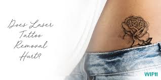 We reveal how much your tattoo removal procedure is likely going to hurt. Does Laser Tattoo Removal Hurt Wifh